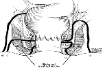 fístula anal