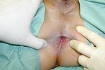fístula anal