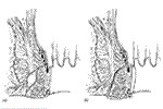 fístula anal