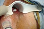 fístula anal